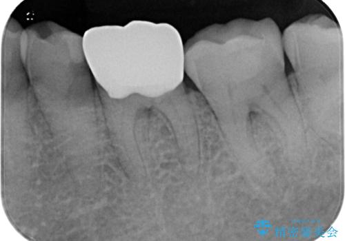 奥歯がたまにしみる フルジルコニアクラウンの補綴治療の治療後
