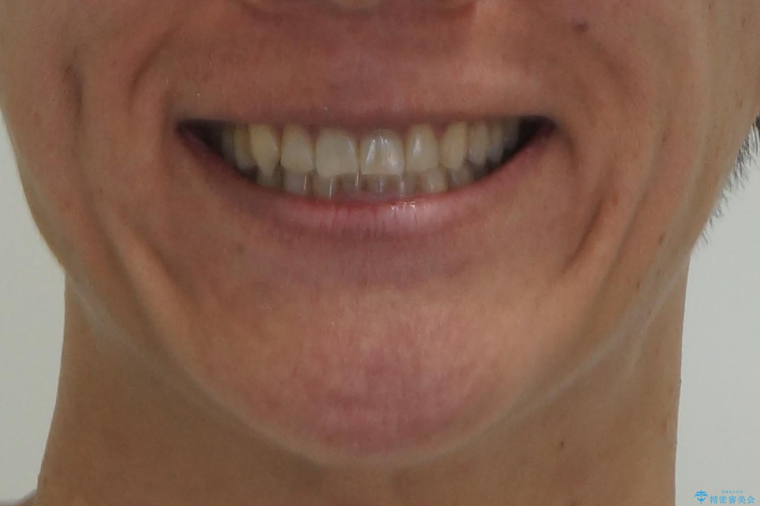 八重歯と下の歯のがたつき マウスピースでの治療後(顔貌)