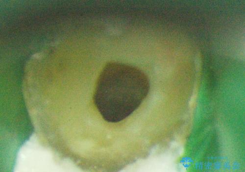 前歯の根のところに違和感がある|根尖性歯周炎|精密根管治療|オールセラミッククラウン|見た目も改善の治療中
