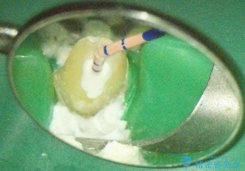 前歯の根のところに違和感がある|根尖性歯周炎|精密根管治療|オールセラミッククラウン|見た目も改善の治療前