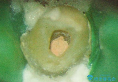 前歯の根のところに違和感がある|根尖性歯周炎|精密根管治療|オールセラミッククラウン|見た目も改善の治療後