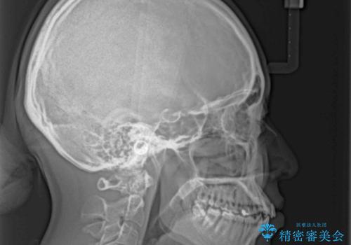 奥歯の咬み合わせのズレと前歯の突出感　変則的な抜歯矯正の治療前