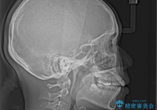 欠損と口元の突出感 ワイヤー装置での抜歯矯正の治療前