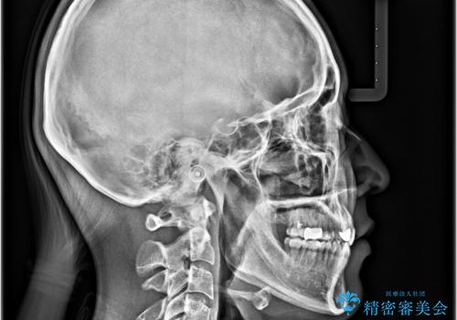 奥歯の咬み合わせのズレと前歯の突出感 変則的な抜歯矯正の治療後