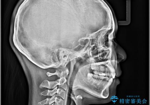 欠損と口元の突出感 ワイヤー装置での抜歯矯正の治療後