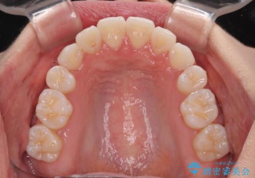 【モニター】八重歯と正中を改善 ワイヤー装置の抜歯矯正の治療後