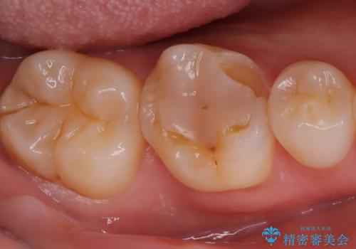 歯が欠けた <セラミッククラウン>の治療前