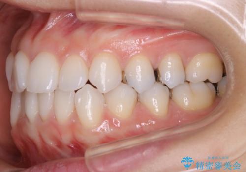 【非抜歯】マウスピースで短期間矯正の治療前