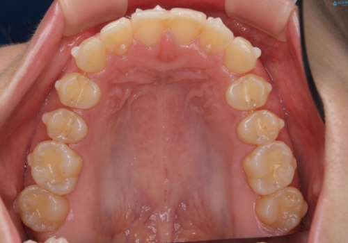 出っ歯に見える前歯の改善 部分ワイヤーとマウスピース矯正の治療中