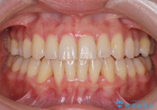 非抜歯(歯を抜かない)の症例 治療後