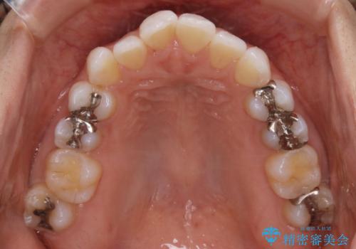 【非抜歯】マウスピースで短期間矯正の治療前