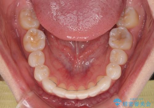 【モニター】八重歯と正中を改善 ワイヤー装置の抜歯矯正の治療後