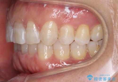 八重歯と下の歯のがたつき マウスピースでの治療中