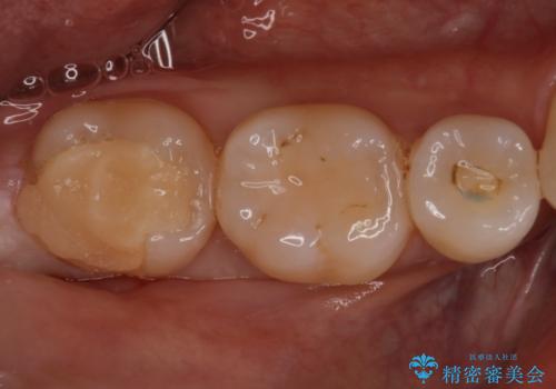昔の被せ物が取れてしまった セラミックアンレーで治療の治療前