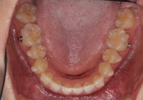 出っ歯に見える前歯の改善 部分ワイヤーとマウスピース矯正の治療中