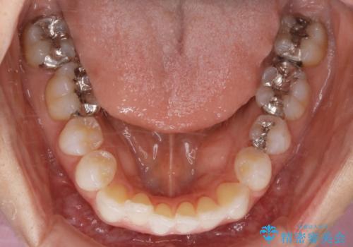 【非抜歯】マウスピースで短期間矯正の治療前