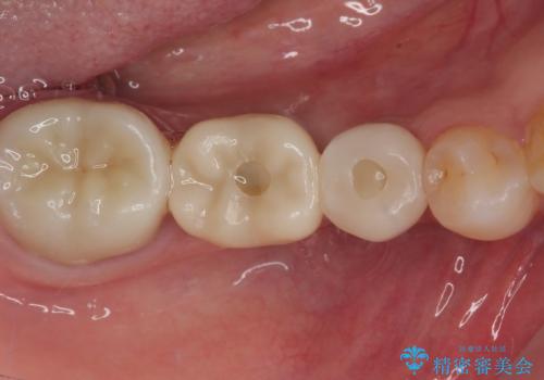 割れてしまった奥歯 インプラント治療の治療後
