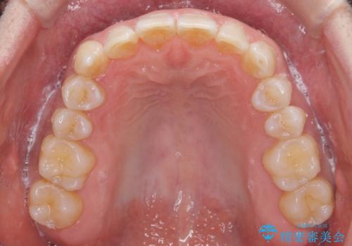 八重歯と下の歯のがたつき マウスピースでの治療中