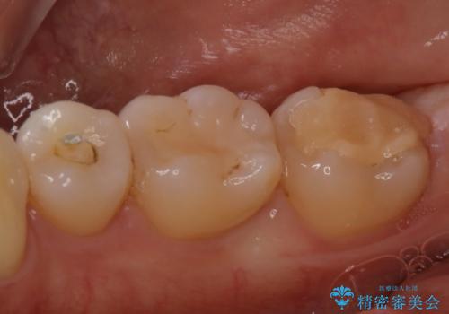 昔の被せ物が取れてしまった セラミックアンレーで治療の治療前