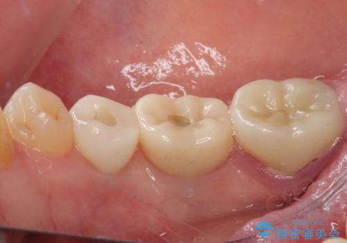 割れてしまった奥歯 インプラント治療の治療後