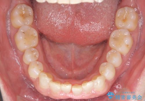 八重歯と下の歯のがたつき マウスピースでの治療中