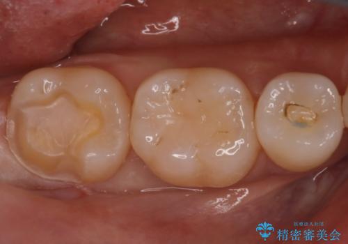 昔の被せ物が取れてしまった セラミックアンレーで治療の治療中
