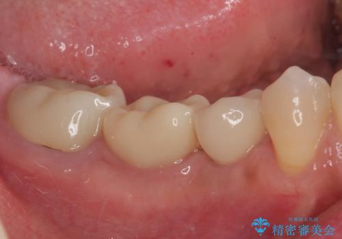 割れてしまった奥歯 インプラント治療の治療後