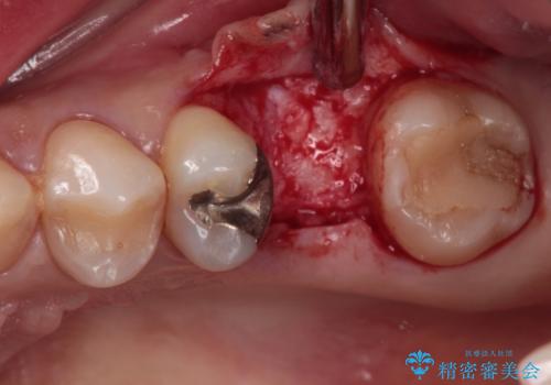 割れてしまった奥歯 インプラント治療の治療前