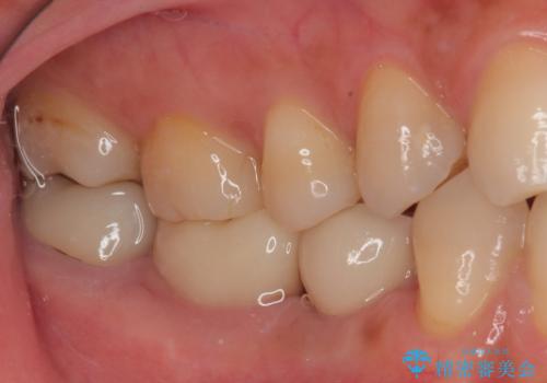 割れてしまった奥歯 インプラント治療の治療後