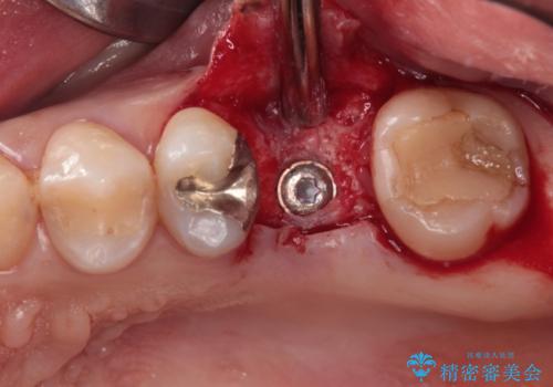 割れてしまった奥歯 インプラント治療の治療中