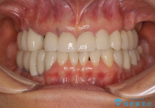 ニューヨークから1泊で通院 1DAYインプラントの治療前