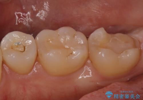 昔の被せ物が取れてしまった セラミックアンレーで治療の治療中
