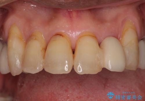 破折した前歯のインプラント 1DAYインプラントで短期間治療