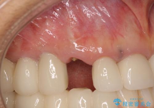 ニューヨークから1泊で通院 1DAYインプラントの治療前