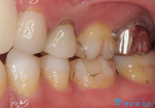 何もしなくても歯がズキズキ痛い 根管治療とオールセラミッククラウンによる補綴の治療前