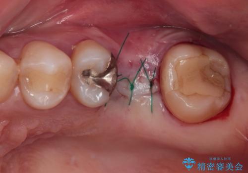 割れてしまった奥歯 インプラント治療の治療後