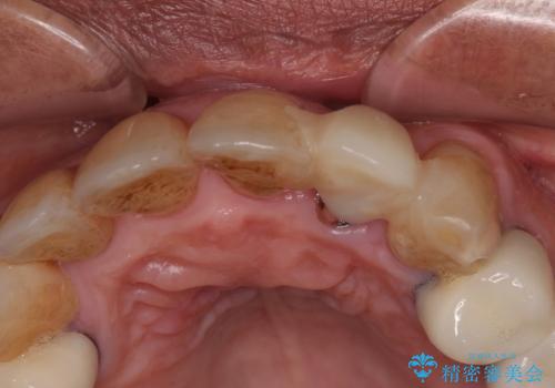 破折した前歯のインプラント 1DAYインプラントで短期間治療の治療前