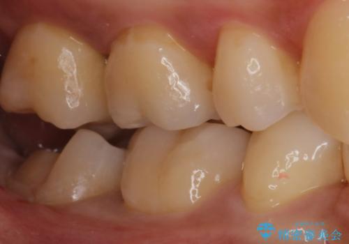 昔の被せ物が取れてしまった セラミックアンレーで治療の治療中