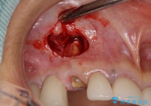 ニューヨークから1泊で通院 1DAYインプラントの治療前
