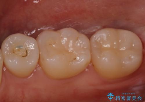 昔の被せ物が取れてしまった セラミックアンレーで治療の治療後