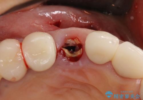 ニューヨークから1泊で通院 1DAYインプラントの治療前