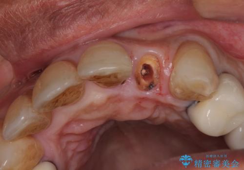 破折した前歯のインプラント 1DAYインプラントで短期間治療の治療前
