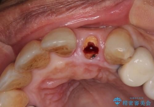 破折した前歯のインプラント 1DAYインプラントで短期間治療の治療中