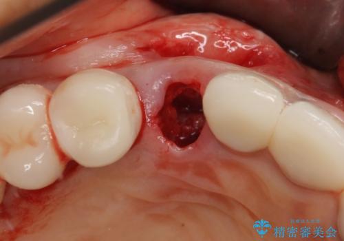 ニューヨークから1泊で通院 1DAYインプラントの治療中