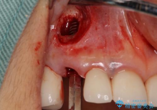 ニューヨークから1泊で通院 1DAYインプラントの治療中