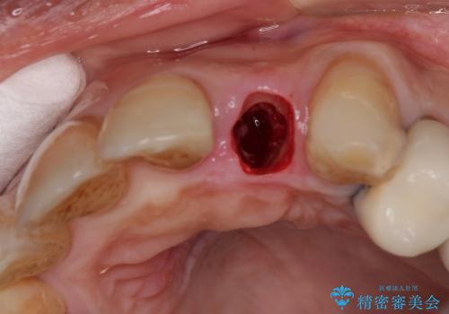 破折した前歯のインプラント 1DAYインプラントで短期間治療の治療後