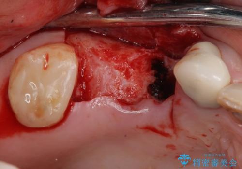 奥歯で噛みたい 破折した歯のインプラント治療の治療前