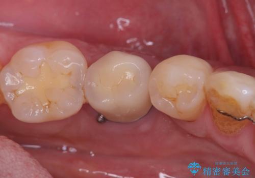 20年前にいれたインプラント|インプラント周囲炎|古いインプラントを除去しインプラント再埋入|痛く無いインプラント治療の治療中