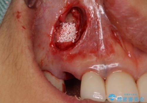 ニューヨークから1泊で通院 1DAYインプラントの治療後