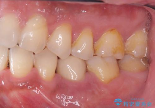 20年前にいれたインプラント|インプラント周囲炎|古いインプラントを除去しインプラント再埋入|痛く無いインプラント治療の治療前